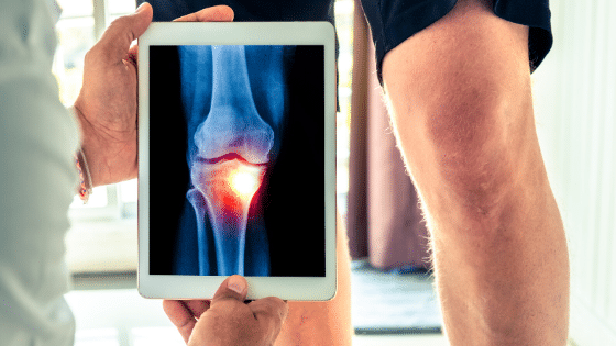 Knee Surgeries vs Knee Injections: 5 Things You Need to Understand